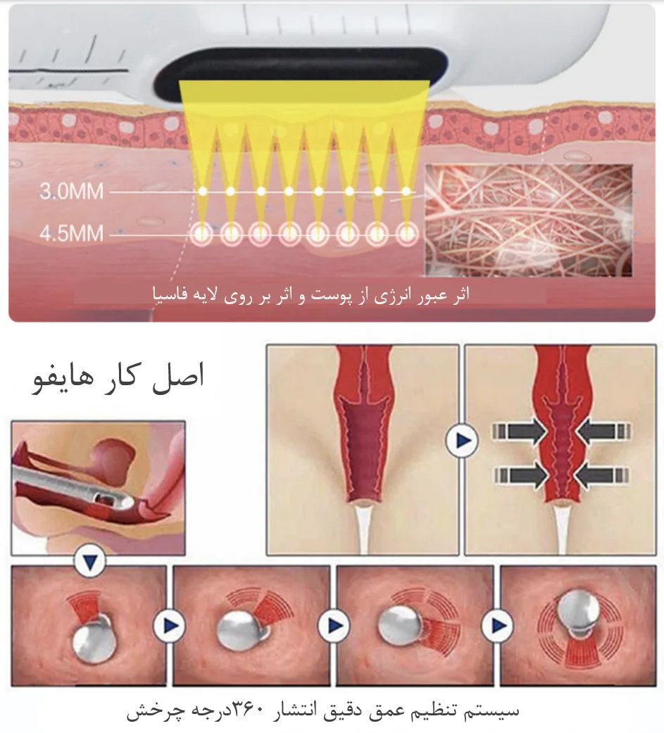 هایفو اولترا لیفت