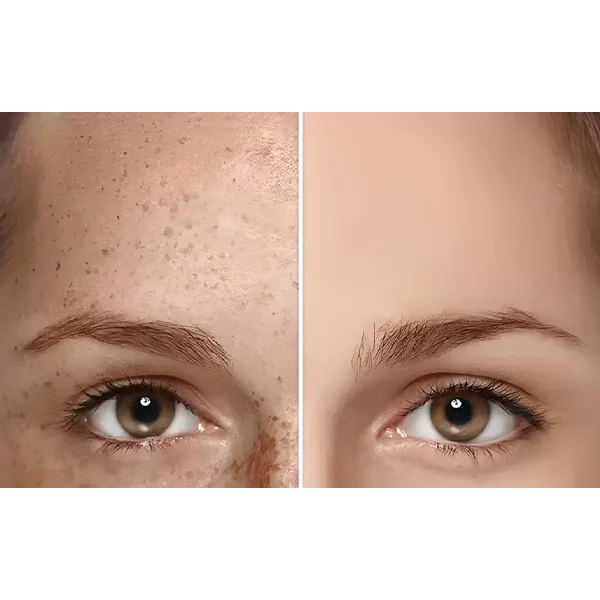 لیزر کیوسوئیچ برای صورت