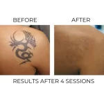 دستگاه لیزر پیکوسکند کیوسوئیچ